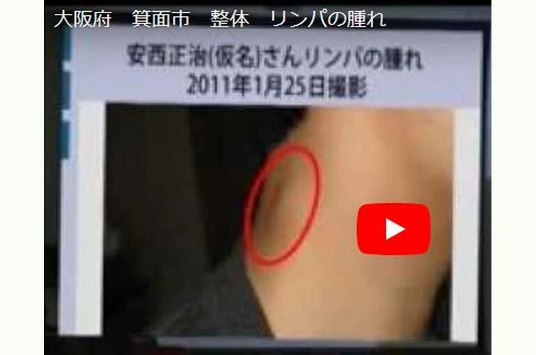 悪性リンパ腫疑いキャプチャ