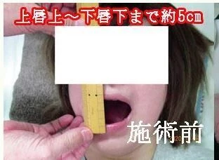 本所悠里様顎関節キャプチャ