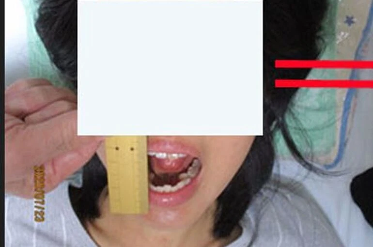 山本満里奈様　顎関節1